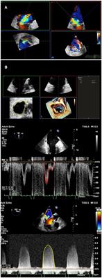 Percutaneous Mitral Valve Repair: Multi-Modality Cardiac Imaging for Patient Selection and Intra-Procedural Guidance